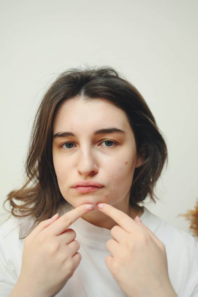 pressure around the blackhead