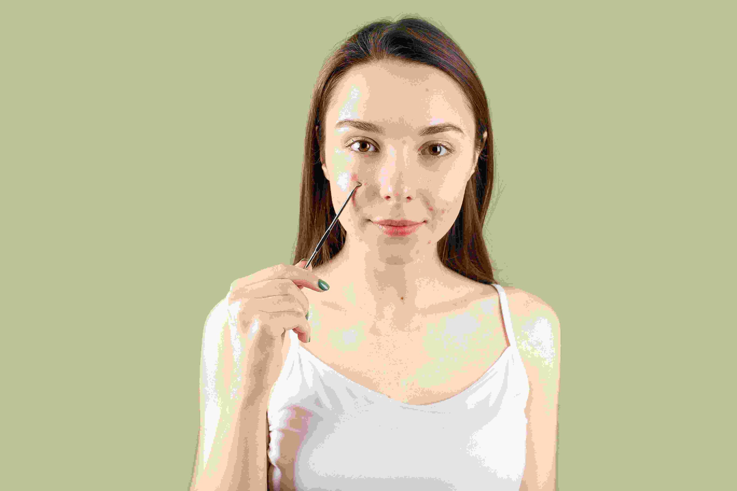 How to Treat Cystic Acne Without Causing Scars: A Complete Guide