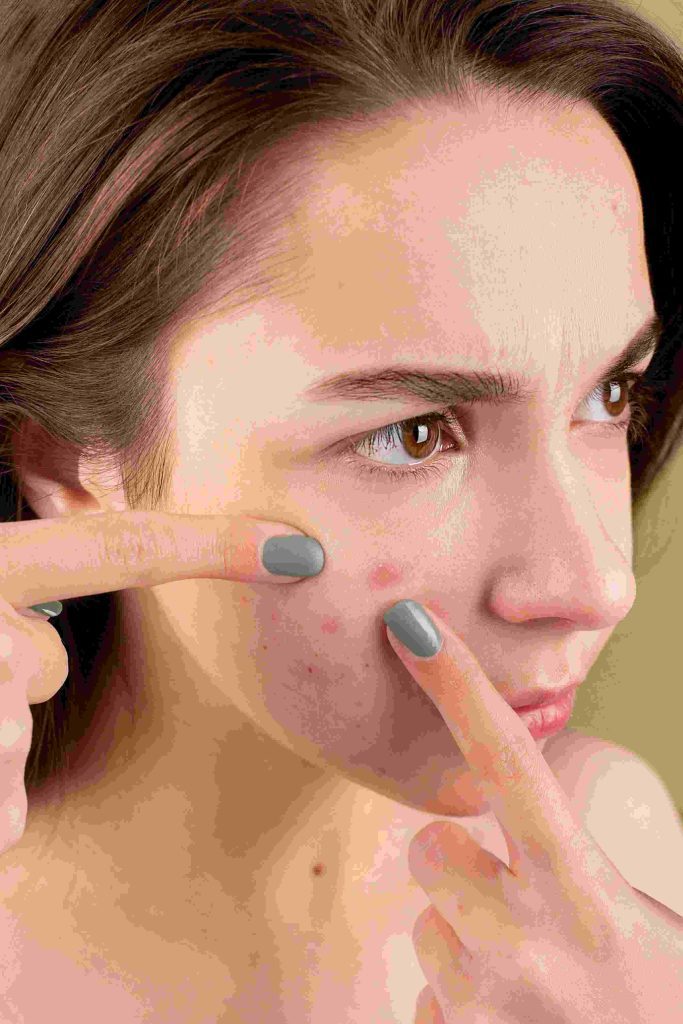 Treat Cystic Acne
