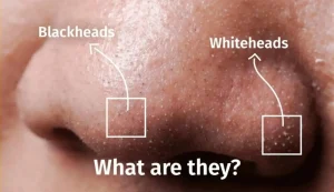 Side-by-side comparison of blackheads and whiteheads.