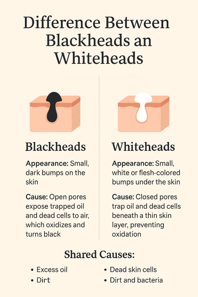 Comparison between blackheads and whiteheads on facial skin.