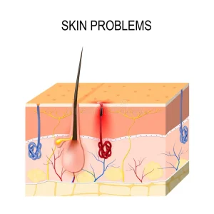 Cross-section of a clogged skin pore showing oil, dead skin cells, and bacteria.