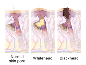 Illustration of an open skin pore forming a blackhead.